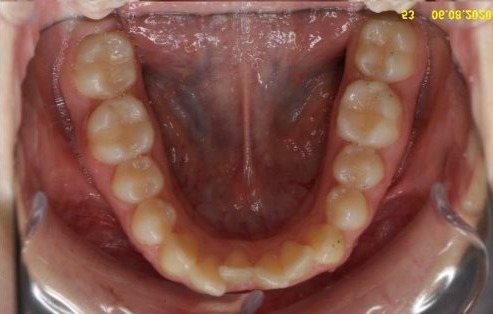 so syllable calf Arhive before and after aparat dentar invizibil - Ortodontie-Bucuresti.ro